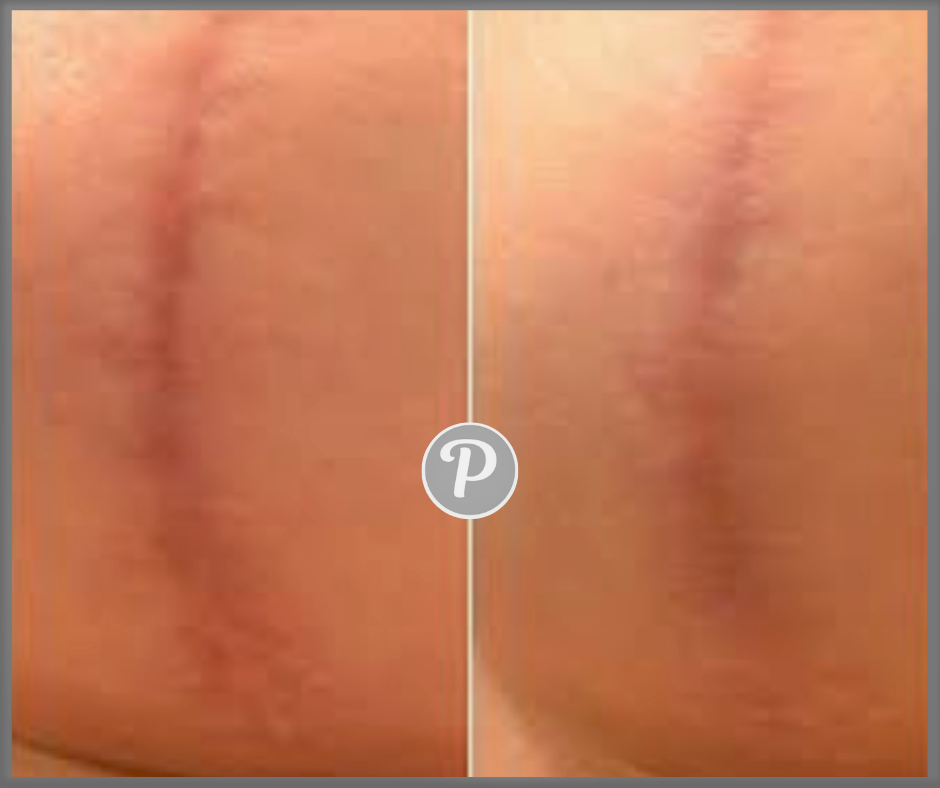 scar.png