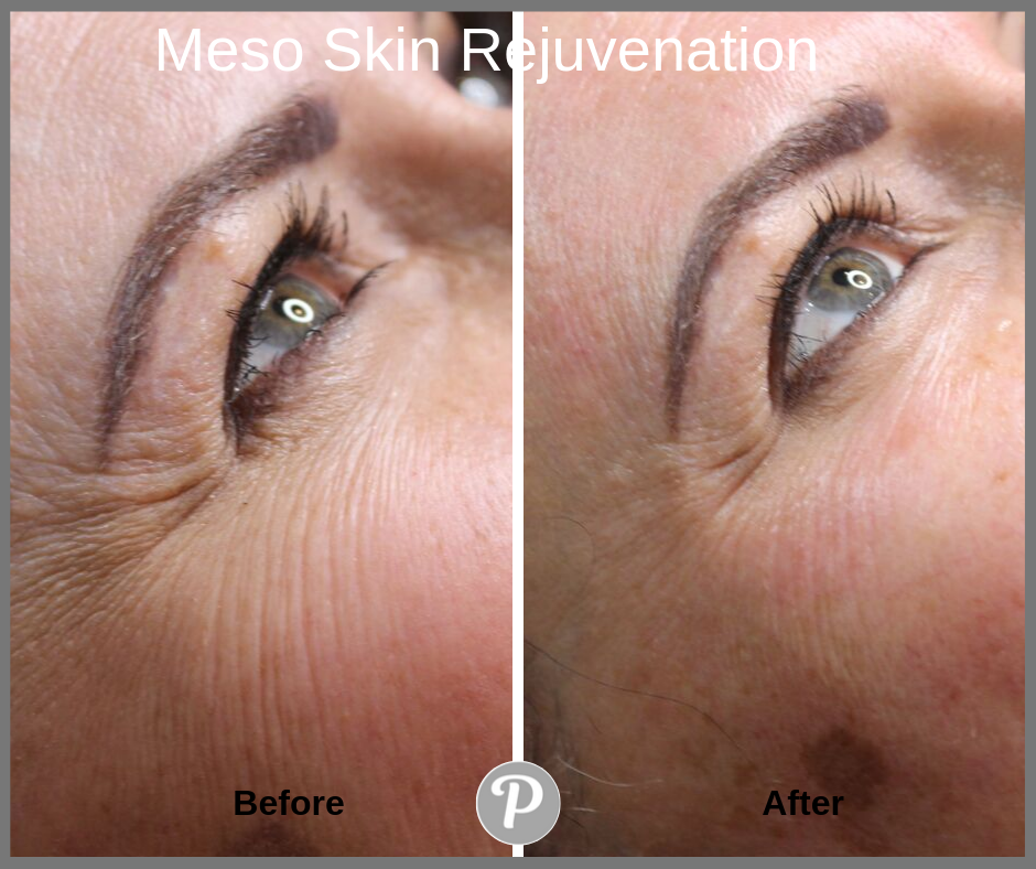 Meso Skin Rejuvenation.png