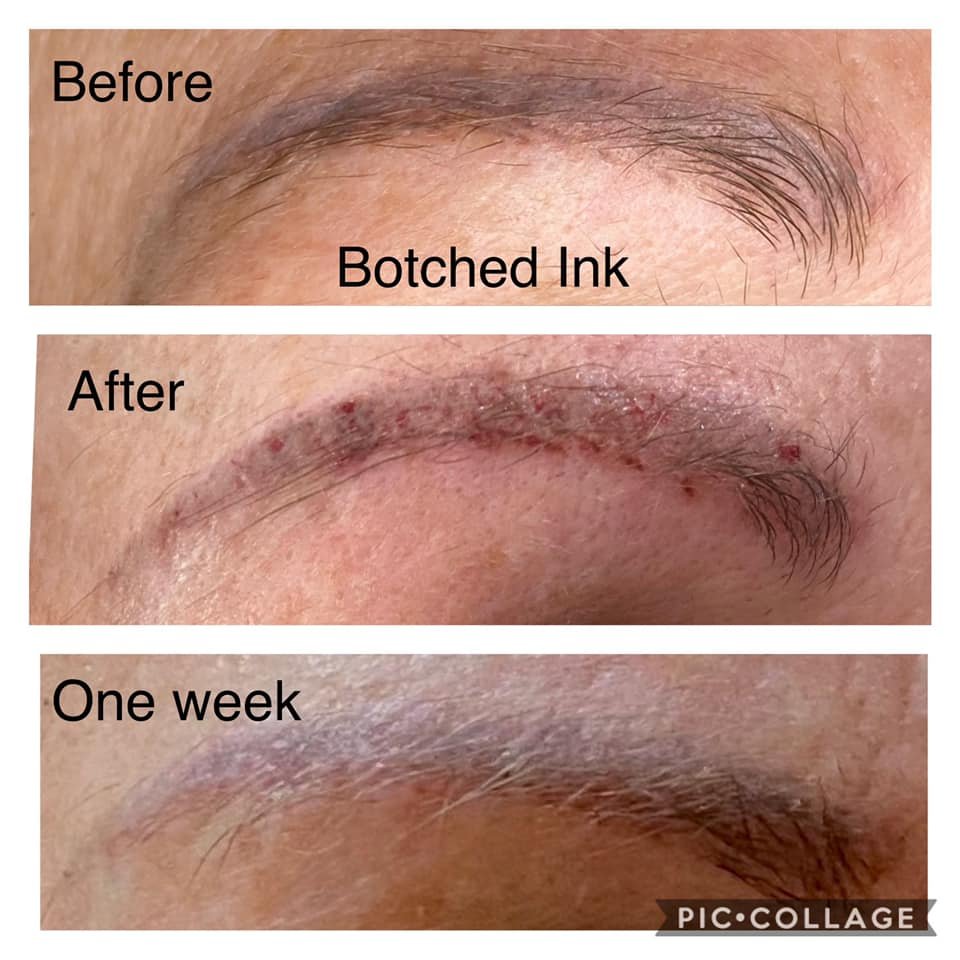 Removal of tattoo eyebrows or lip tattoo. Botched Ink saline removal  procedure. — The Pennington Clinic semi permanent makeup, microblade  eyebrows, meso skin rejuvenation, areola tattoo, dermaplane