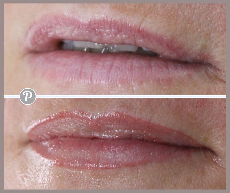 Lip Procedure

As we get older our lips loose their plumpness and definition (such fun!), having your lip pigment tattooed into your lips will redefine the vermillion border making your lips look fuller (with no filler!).

These photos are taken dire