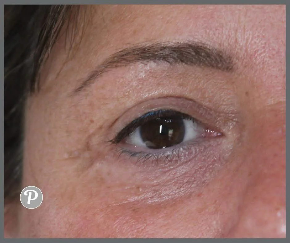 Here is a great example of healed tattoo eyebrow and upper eyeliner.

Emma implants the brow pigments in your skin in a soft smattering of colour in the agreed shape behind the clients natural brow hair to look as natural as possible. This is a powde