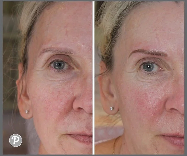 Soft powder brows for this lovely lady.

We are colour correcting some older work here - you can see in the &ldquo;before&rdquo; pics that there is a grey tinge in the background of her brows where old pigment has faded, Emma has implanted a much war