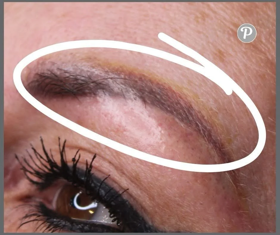 We are seeing lots of clients who need their VERY old semi permanent eyebrows removed, or who have been elsewhere and had awful procedure.

Years ago - the pigments that we used were not as sophisticated as they are today. As they faded in your skin 