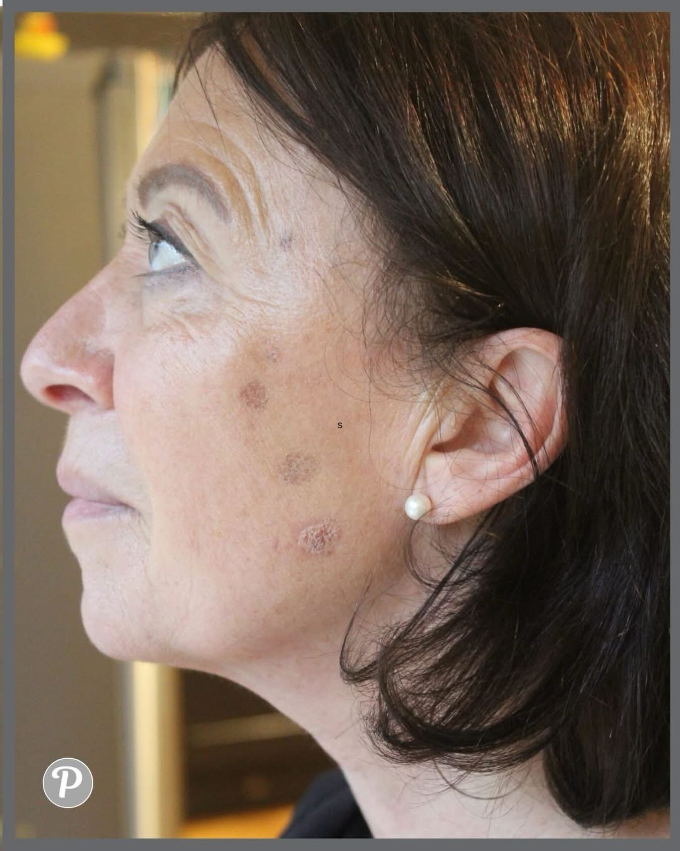 This is what happens when we have a gap between clients; Emma has tackled her own sun spots with our cryo pen!

This photo was taken three days after treatment - you can see the darkened skin that will dry and flake away leaving fresh new skin!

You 