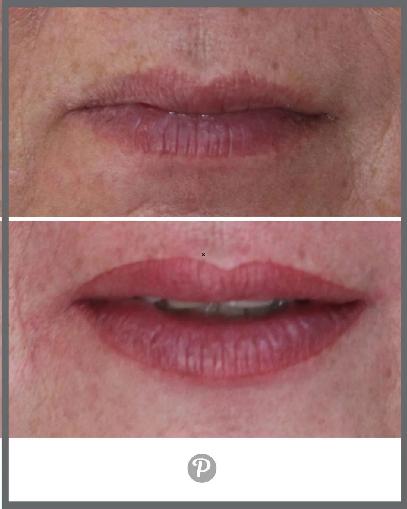 💋 Rediscover Your Smile with Semi-Permanent Lip Makeup 💋

As we age, our lips can lose definition, colour, and fullness &mdash; but confidence doesn&rsquo;t have to fade with them. At The Pennington Clinic, Emma uses advanced semi-permanent makeup 
