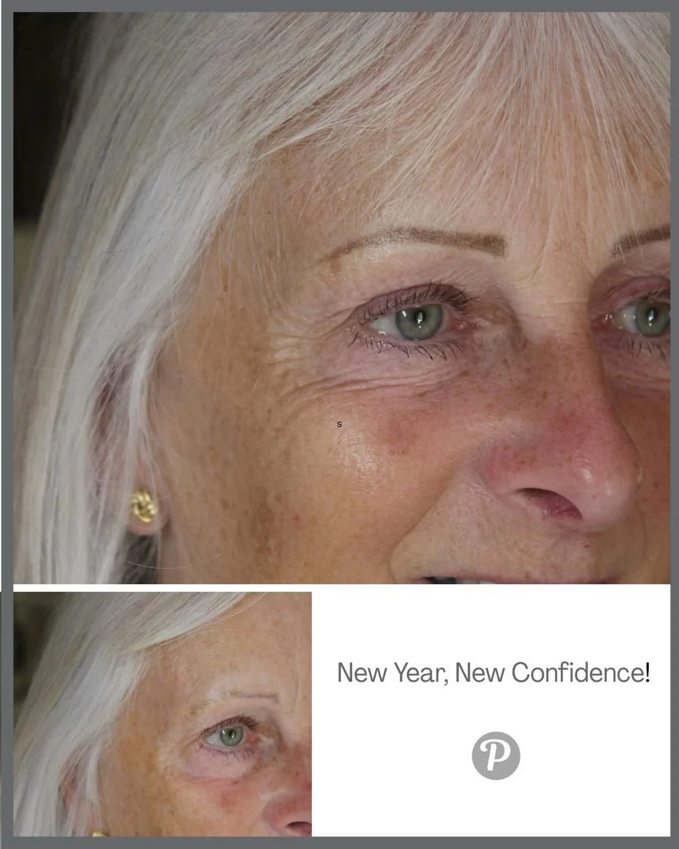 Thinking about enhancing your brows, lips, or skin in 2026? Now&rsquo;s the perfect moment to plan your beauty goals. Our treatments are all about subtle, natural‑looking results that help you feel your best.

The Clinic is closed for procedure until