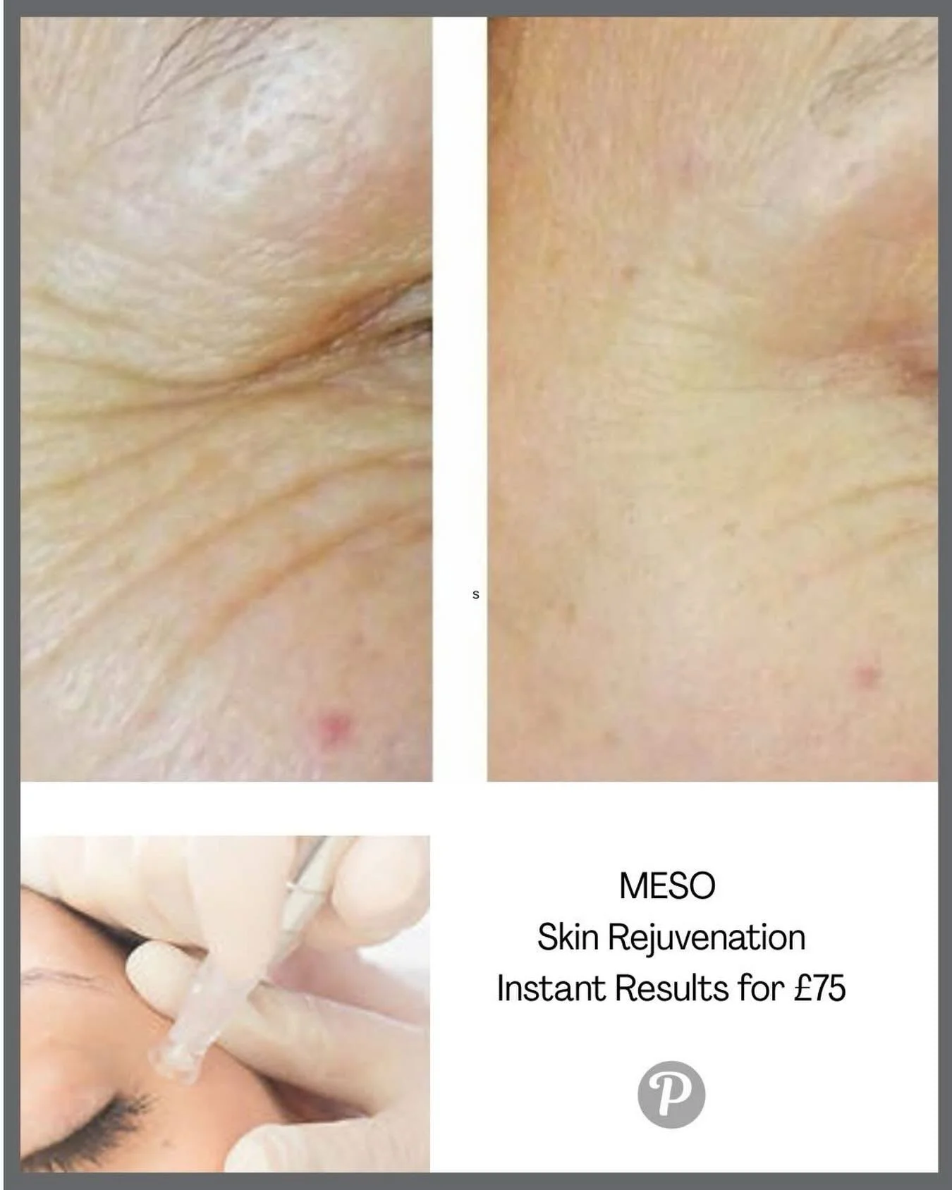 Cold weather can leave skin feeling dull and tired. 

A gentle rejuvenation treatment like MESO can help restore brightness and softness. 

A little self‑care at this time of year goes a long way.

Message to book in!

www.thepenningtonclinic.co.uk

