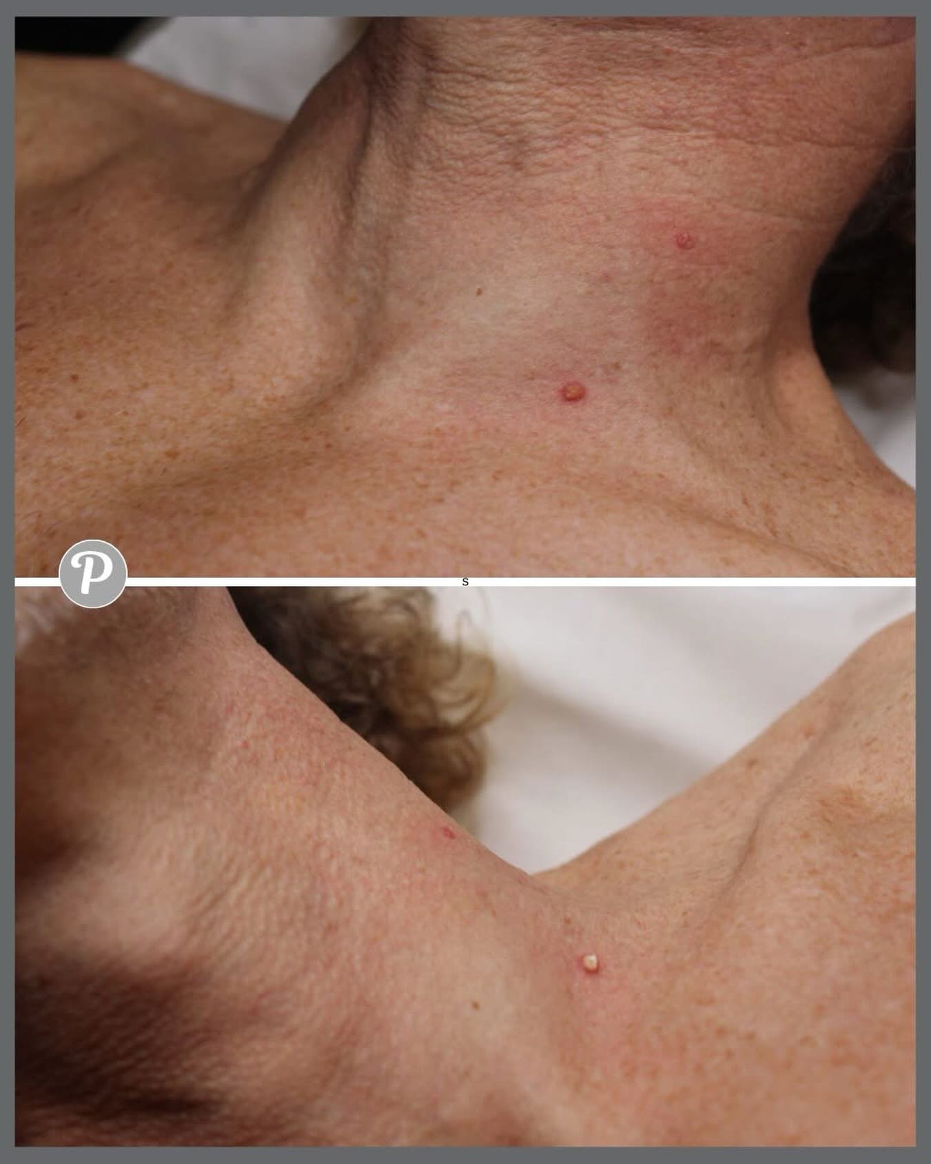 ✨ Smooth, clear skin starts here ✨
Say goodbye to skin tags and unwanted pigmentation with Cryotherapy at The Pennington Clinic.
A quick, painless treatment that removes:
&bull; Skin tags
&bull; Sun spots
&bull; Age spots
&bull; Hyperpigmentation
Tre