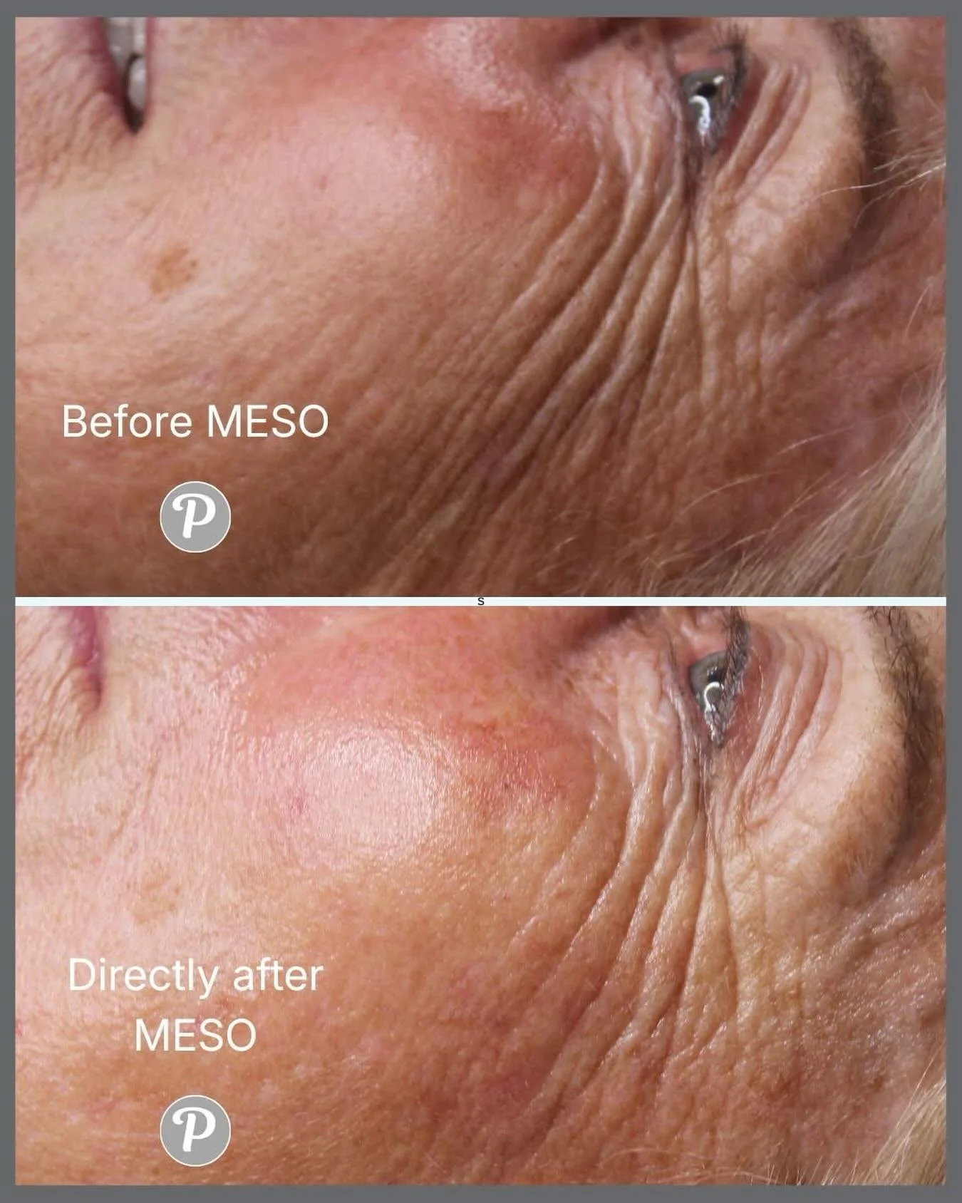 ✨ A little boost can go a long way ✨
A single MESO treatment (&pound;75) at The Pennington Clinic can make a noticeable difference &mdash; even for mature skin. 

It won&rsquo;t turn the clock back to when you were 21, and it&rsquo;s not meant to. Wh