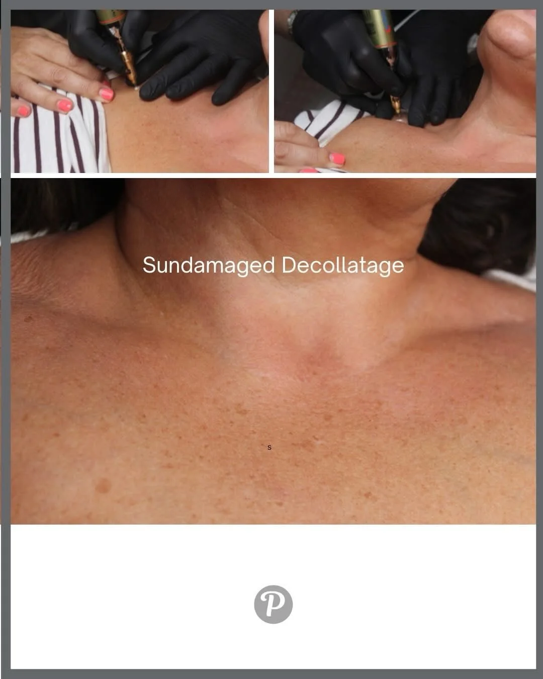 We all have sun damage - it is often our d&eacute;colletage, or faces that have taken the brunt of our sun worshipping and we have sun damage in the form of sun spots or age spots.
These can be treated really simply with cryotherapy: an accurate jet 