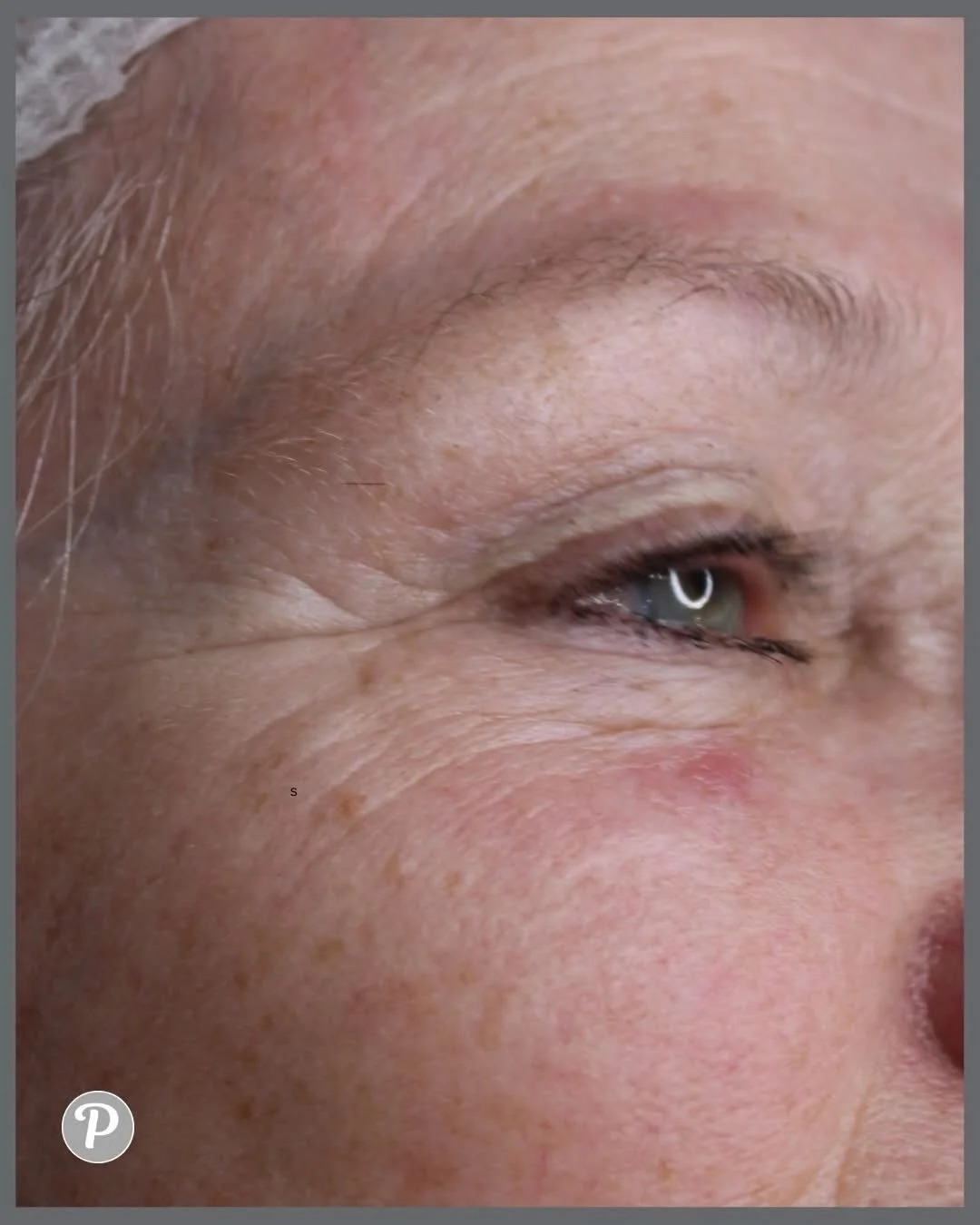 Amazing results for just &pound;75

These photos are before and after one single MESO skin rejuvenation session! 

Look at how  plumped up and moisturised the skin is. This gentle skin needling procedure is the only one that can work right up to your