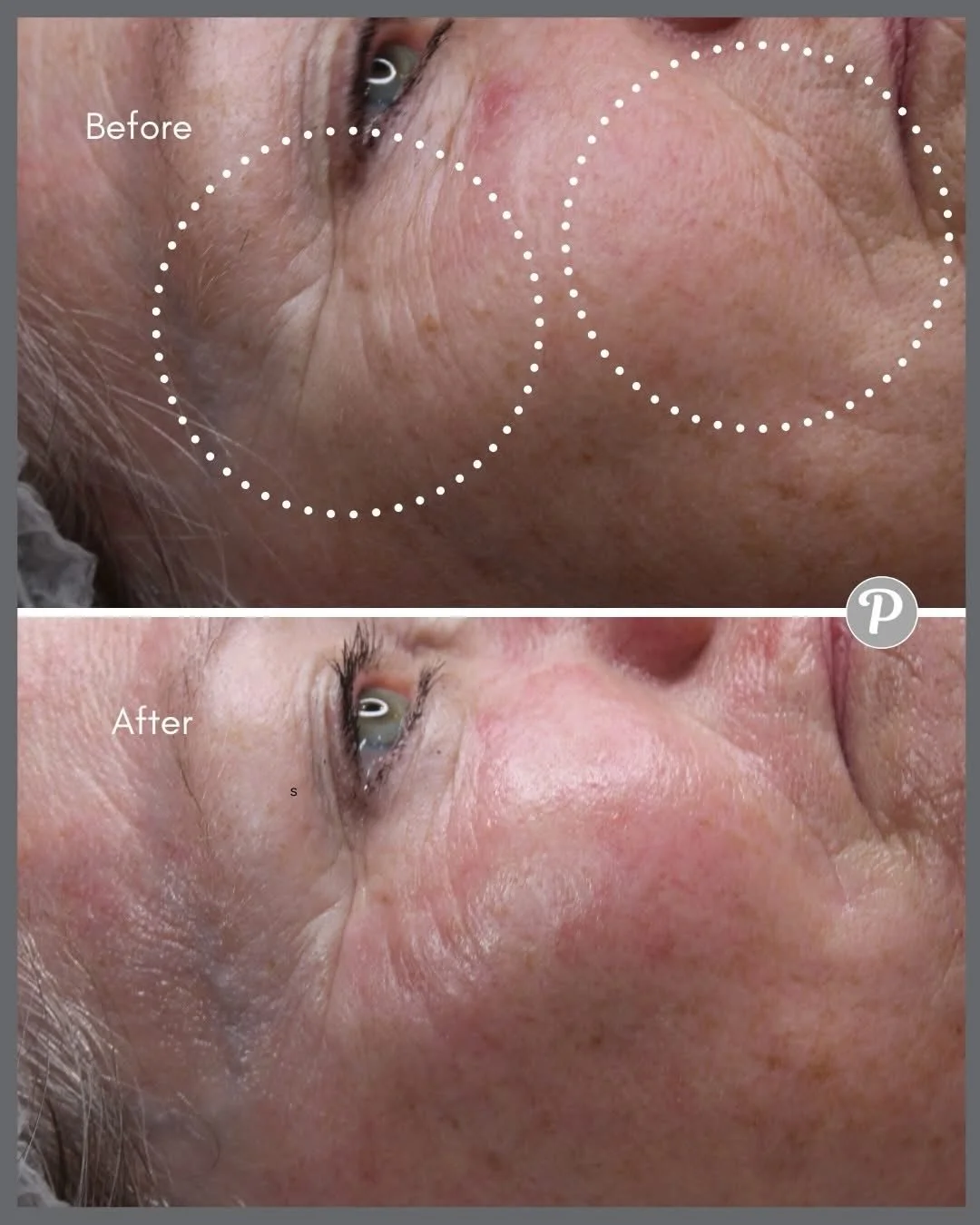 Next level skin rejuvenation: Dermaplaning plus MESO skin needling at The Pennington Clinic

If you&rsquo;re ready to take your skin to the next level, this combo is the ultimate power pair. Dermaplaning gently removes dead skin cells and vellus hair