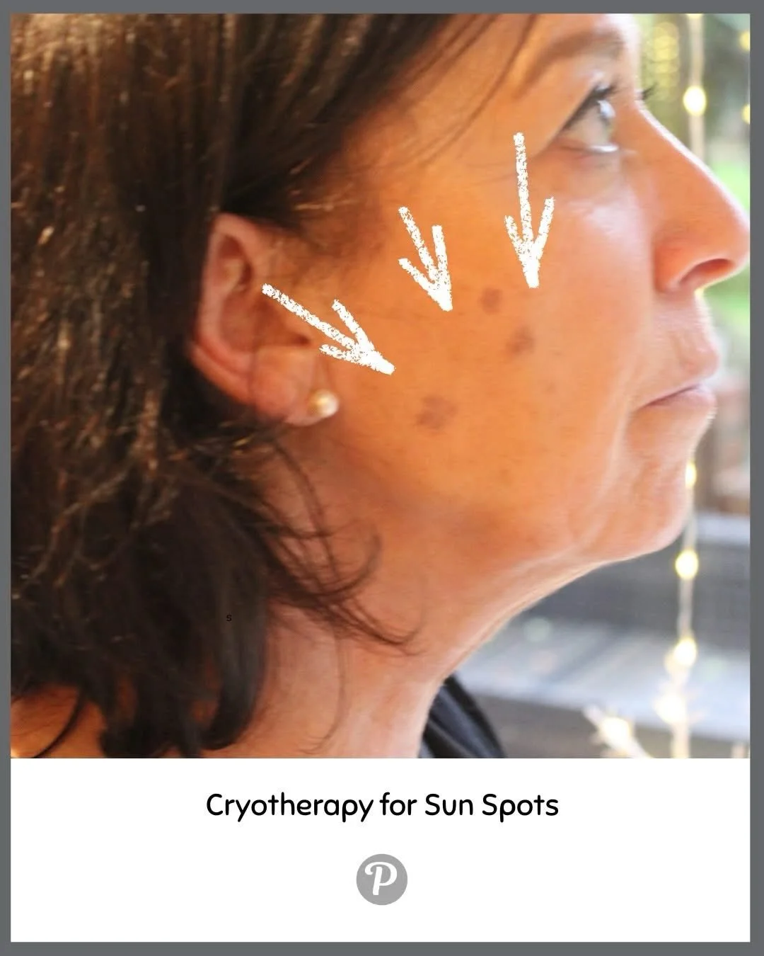 Spring is the ideal time to treat winter-revealed age spots before the summer sun intensifies.

Spring cleaning isn&rsquo;t just for your home!

Treat those stubborn sun spots now so your skin is clear and glowing before summer arrives.

Cryotherapy 