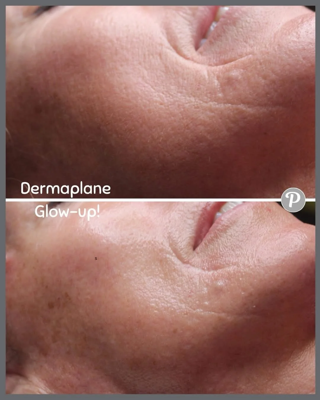 Ready to say goodbye to dull skin and hello to an instant, radiant glow? If you haven&rsquo;t tried dermaplaning yet, you&rsquo;re missing out on one of the best &ldquo;glow-up&rdquo; secrets in skincare!
Dermaplaning is a gentle exfoliation treatmen