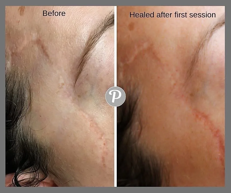 At The Pennington Clinic, we use Dry Needling (also known as MCA Skin Needling) to physically break down tough, fibrous scar tissue. By using a precision digital machine without pigment, we trigger the body&rsquo;s natural healing response to relax t