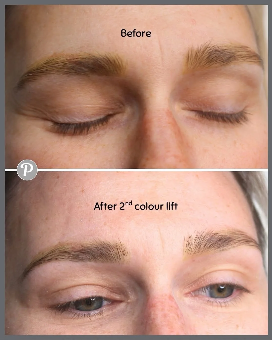 The Final Step in Your Eyebrow Removal Journey: Why Clients Come to The Pennington Clinic After Laser 

If you have tattooed brows that you are not happy with, laser removal is an incredible and effective tool, it breaks down and removes the majority