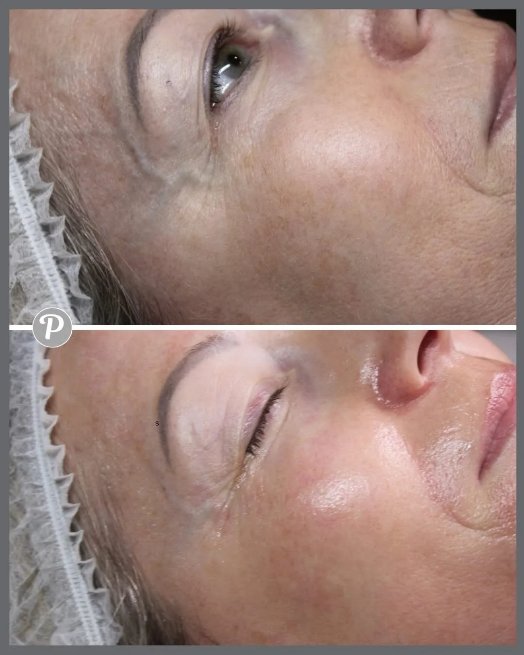 ✨ MESO Skin Rejuvenation (&pound;75) Instant Glow, Softer Lines, Fresher Skin ✨

At The Pennington Clinic, our MESO Skin Rejuvenation treatment has become a favourite for clients who want smoother, brighter, more youthful‑looking skin without anythin