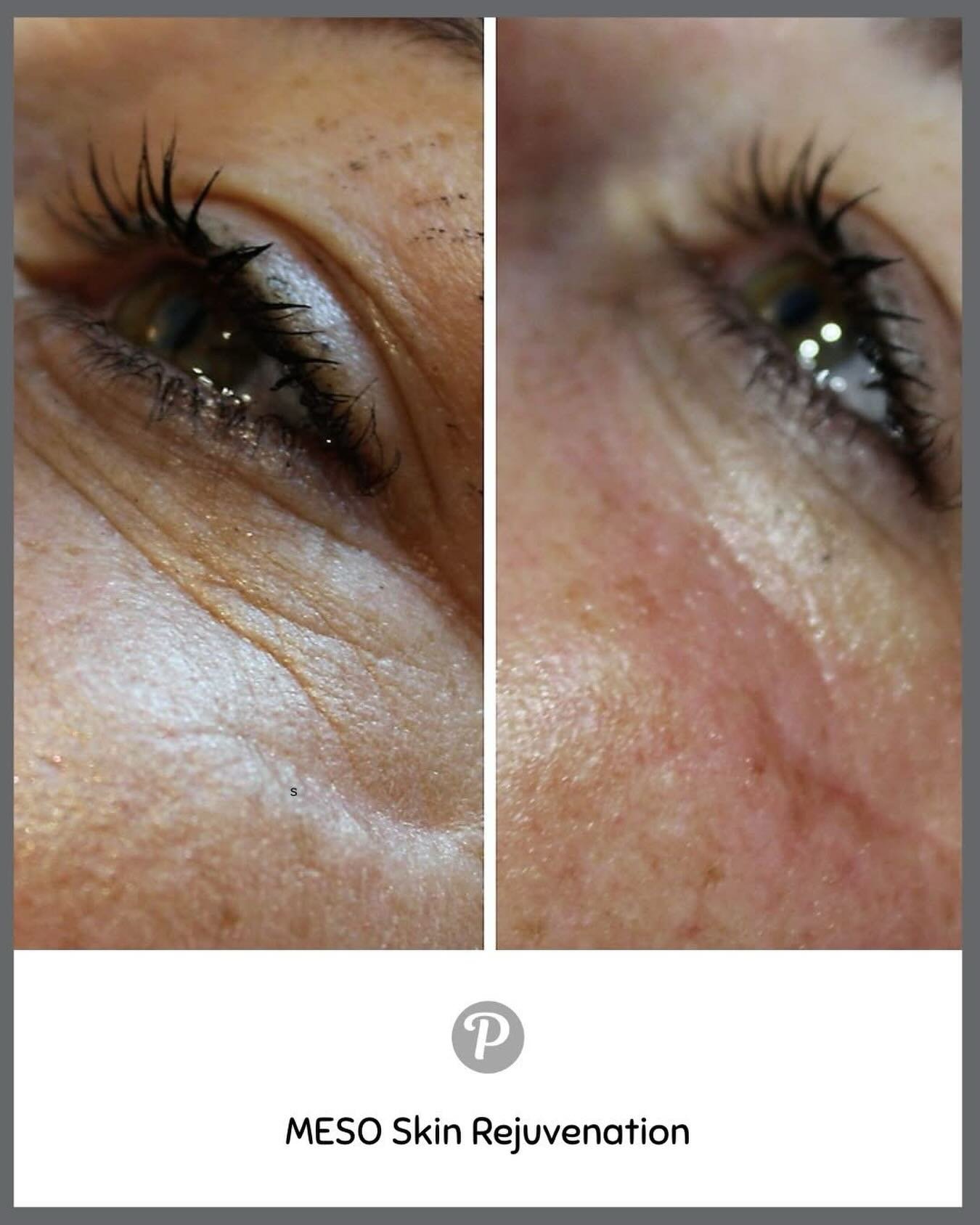 ✨ MESO Skin Rejuvenation - Real Collagen Stimulation, Real Results ✨

If you&rsquo;ve been wondering how to truly boost collagen in your skin, this is the treatment to pay attention to.

At The Pennington Clinic, our MESO Skin Rejuvenation procedure 