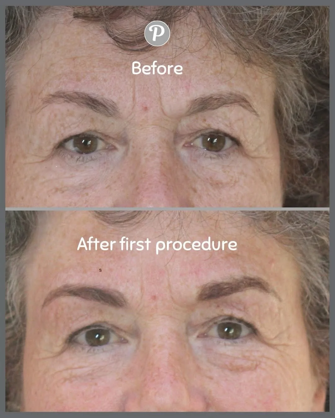 ✨ Your Eyebrow Journey at The Pennington Clinic ✨

Creating natural, confidence‑boosting brows is a gentle process and we take it step-by-step so you never feel overwhelmed or too &ldquo;done&rdquo;.

These images show the full journey:
Before &rarr;