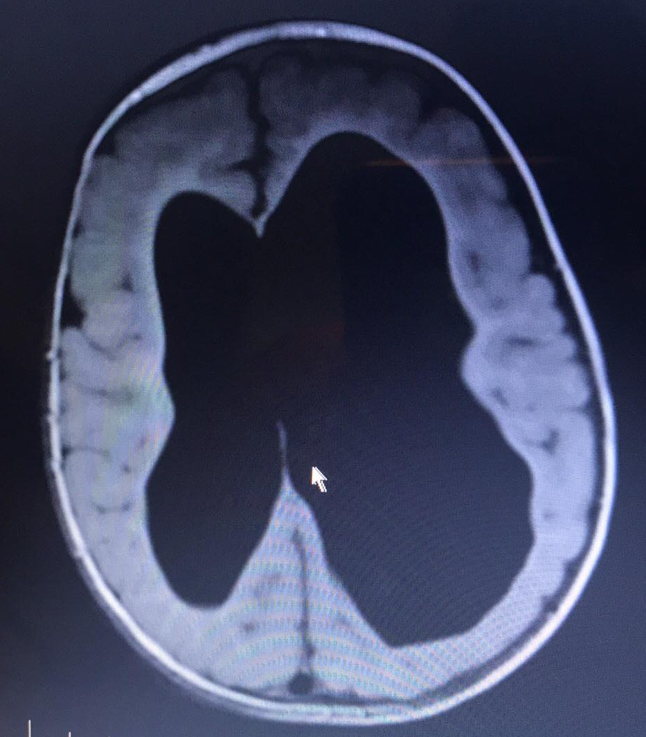 Ventriculomegaly Radiology Key