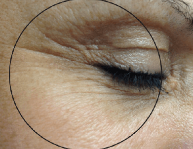 oxegeneo-ultrasound-eyes-before-1.png
