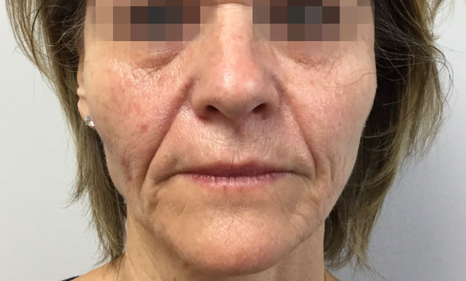 After Sculptra (1 Treatment) By Katie Rehberg
