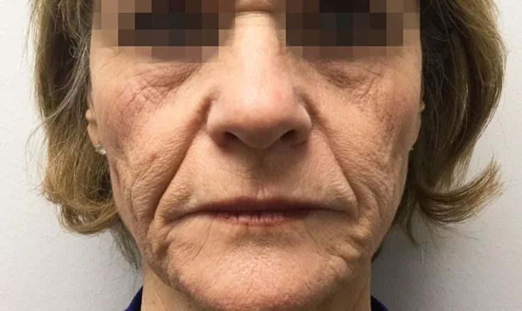 Before Sculptra By Katie Rehberg