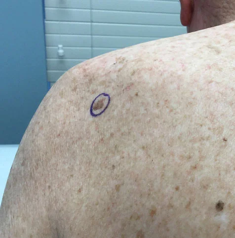 Melanoma Causes Symptoms Treatment Academic Alliance In Dermatology