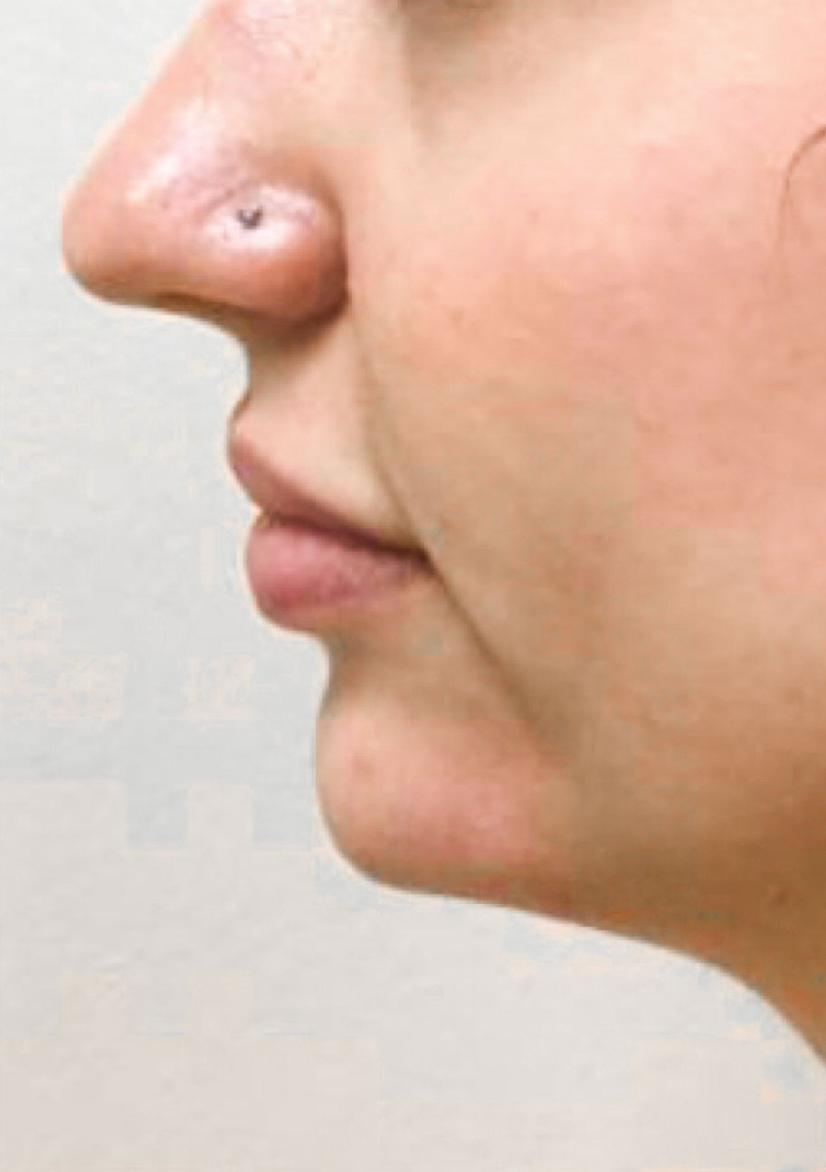After Restylane Lyft (Chin) By Maria Mosos