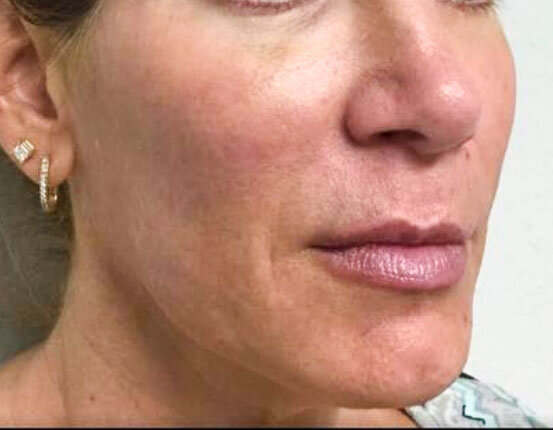 juvederm voluma, what is volbella, what is vollure, Juvederm treatment, fillers, Juvederm treatments Tampa, what is juvederm, juvederm volbella, juvederm voluma, juvederm vollure, dermal fillers, injectables, aesthetics, academic alliance in dermato…