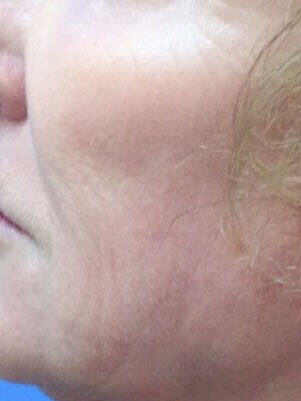 After Ultherapy by Melinda McAlees