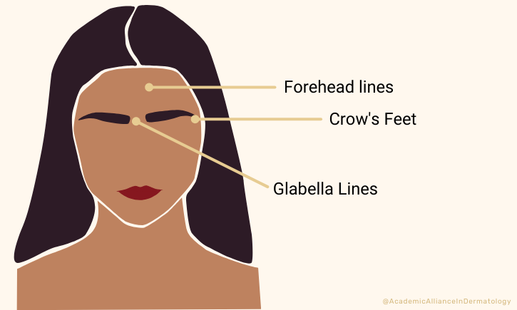 The most common treatment areas for Botox &amp; Dysport are Forehead lines, Crow’s Feet, and Glabella lines