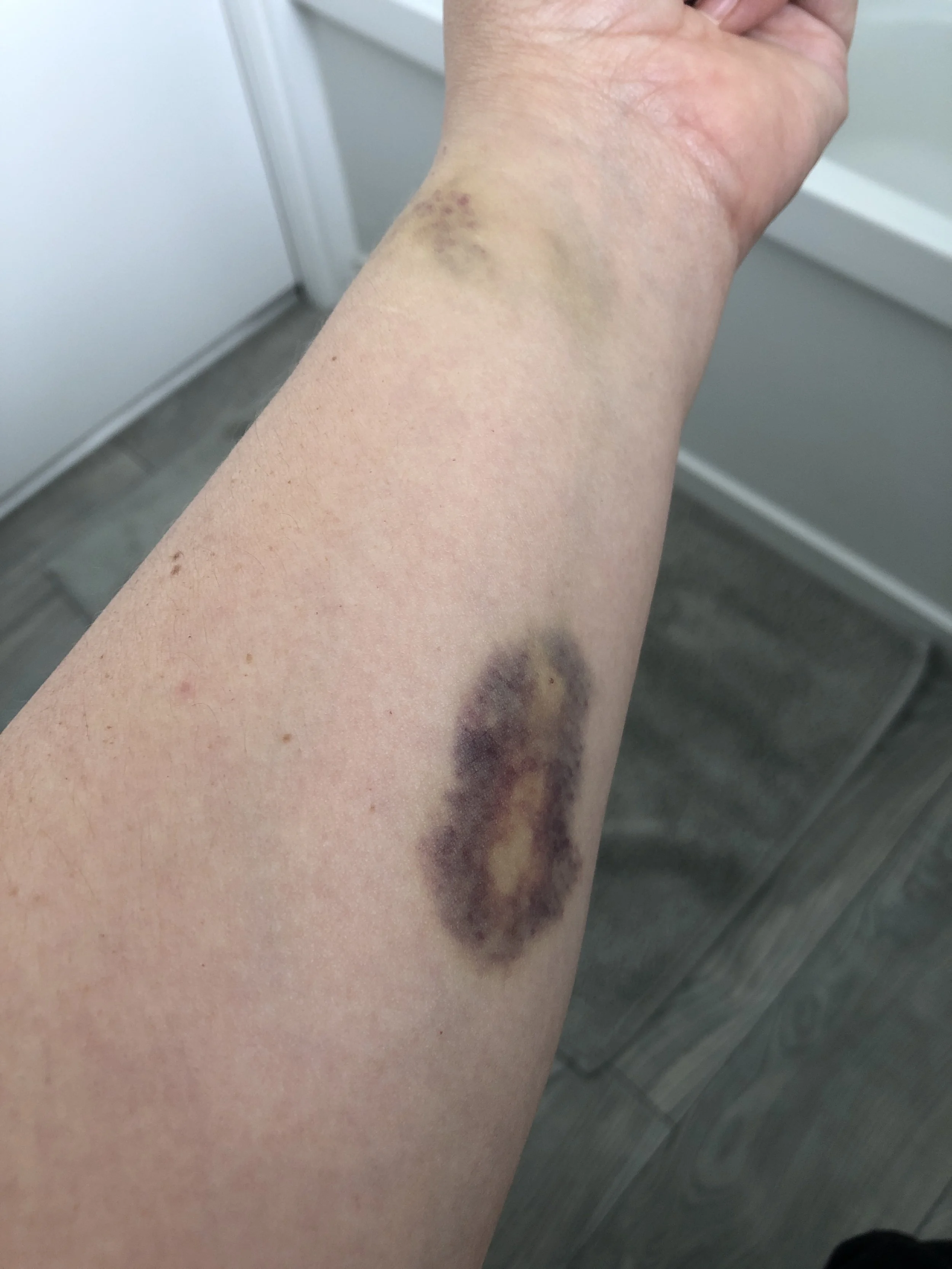 Over a week later and I still have the bruises.