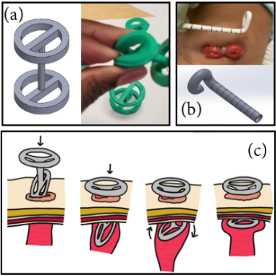 Research Team Awarded Grant for Novel Medical Device to Treat Recurrent Stomal Prolapse