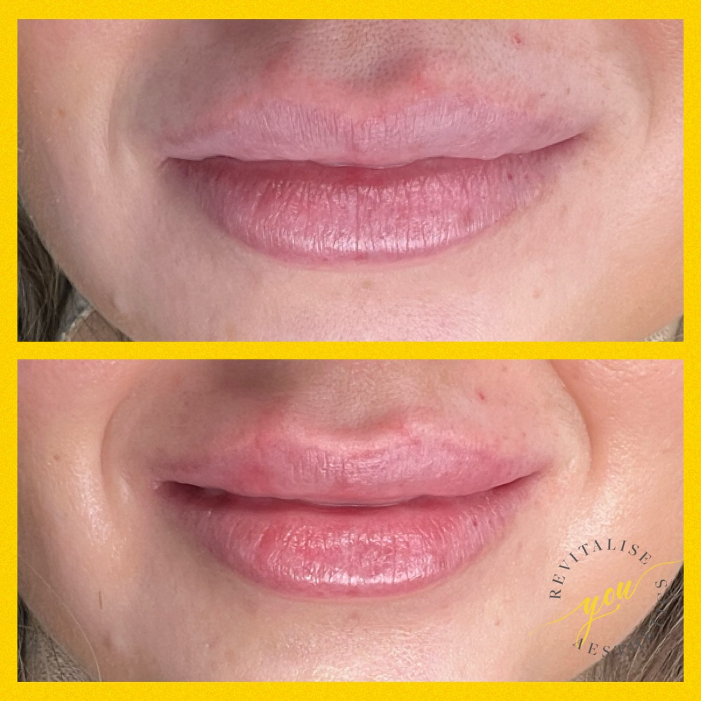 Just a small amount can redefine the lip border and refresh the lips 💋 

Still looking natural and still looking like you

When it comes to lip filler, less is often more&mdash;and that&rsquo;s not just a saying, it&rsquo;s a strategy. Here&rsquo;s 