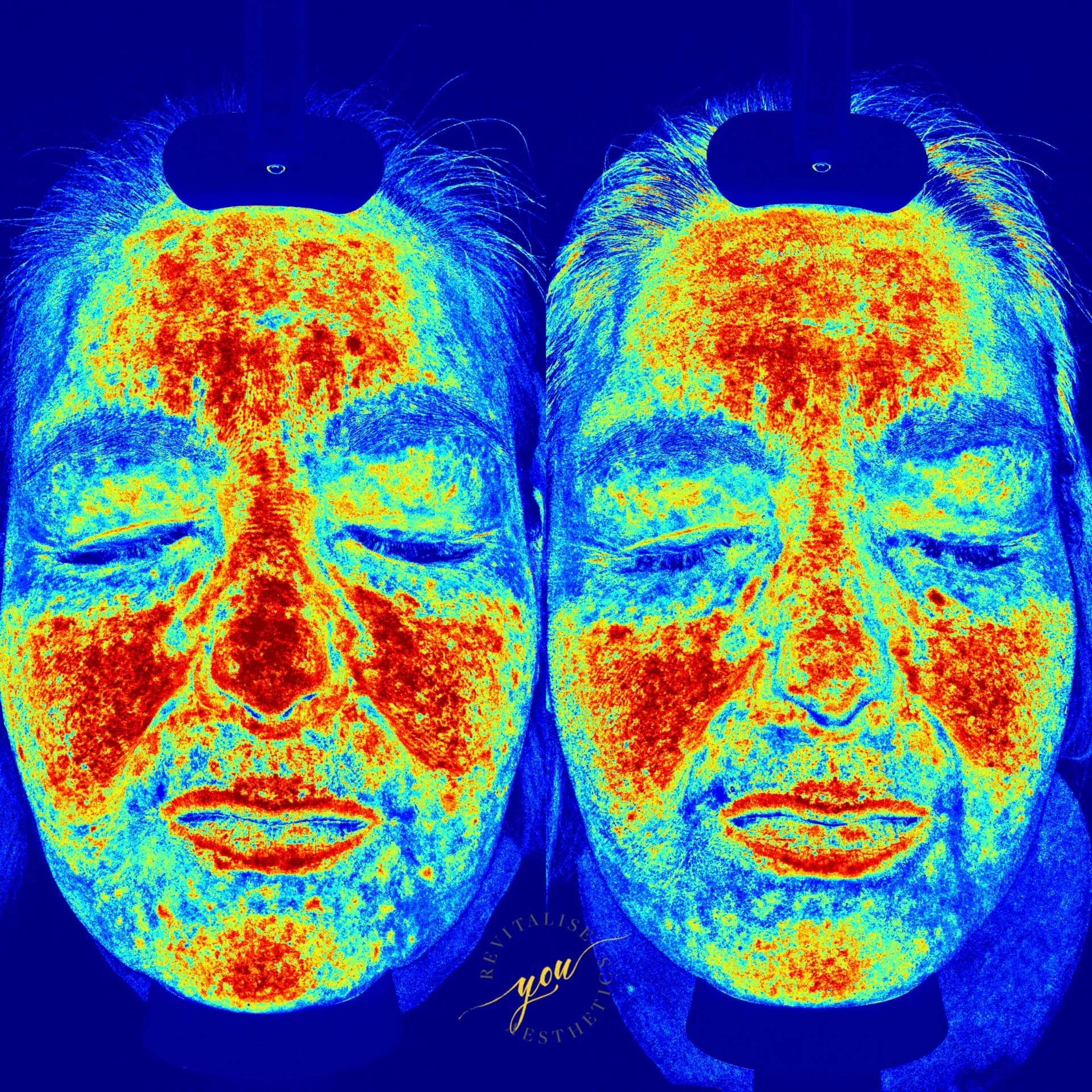 Rosacea skin takes consistency, patience and the right skincare routine. This can feel very frustrating as seen in these skin analysis pictures it works. 

These results were achieved through regular medical-grade skincare used morning and night, hel