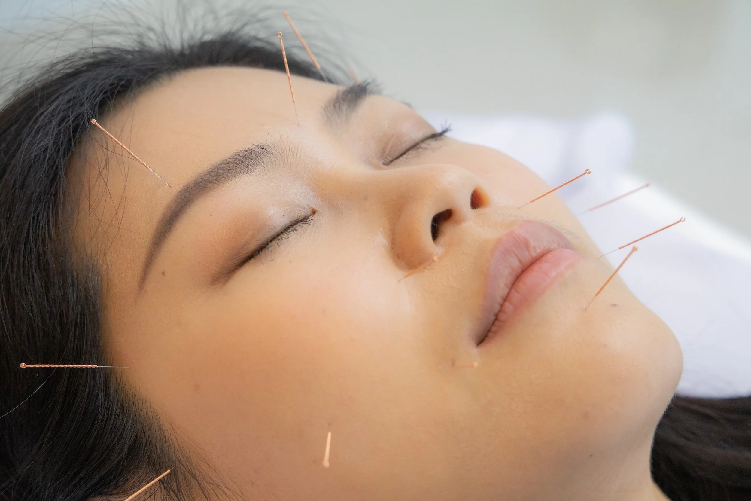 A woman lying face-up with acupuncturist inserting thin needles into her forehead, nose, and face for treatment.