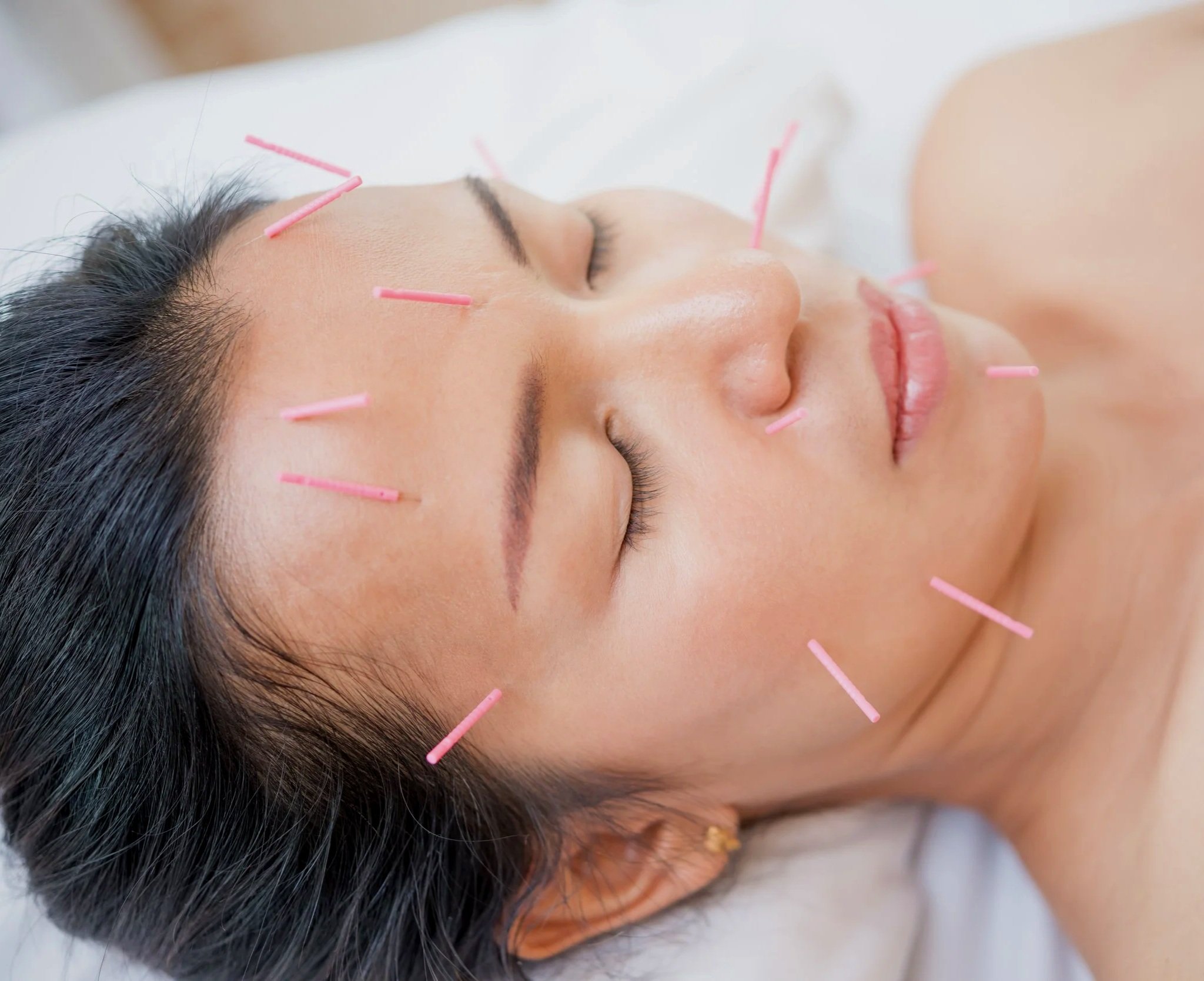 Close-up of a woman lying down with acupuncture needles inserted into her face and forehead.