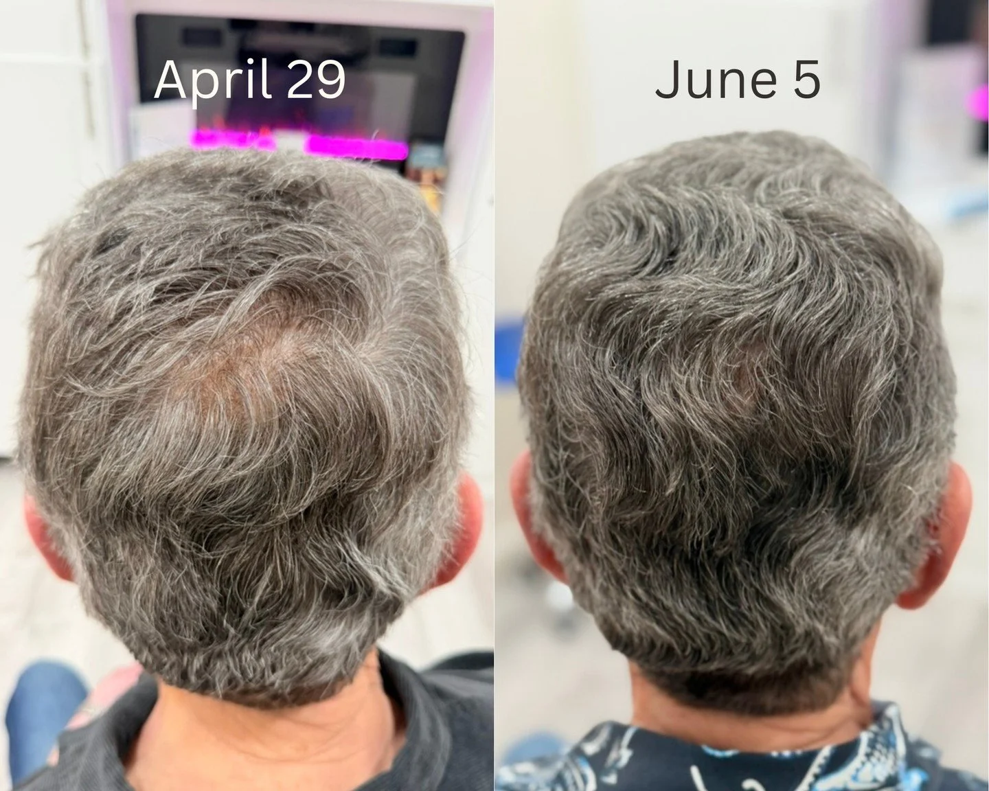 Let&rsquo;s talk about hair thinning. 
It can be stressful, frustrating, and take a real toll on your confidence. But you don&rsquo;t just have to accept it&mdash;and you don&rsquo;t need invasive surgery to fix it. 🫶

This amazing transformation wa