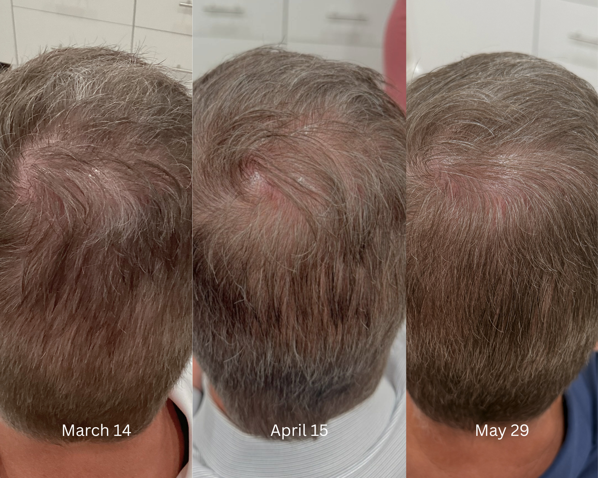 Non-Surgical Hair Restoration Before/After using TargetCool + Protein-Rich Exosomes at Destiny Drip Bar in Southlake, TX