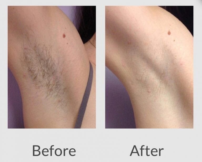 How To Prepare For Laser Hair Removal Underarm