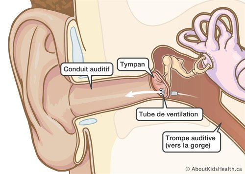 Soins des oreilles avec des tubes — ÉLIE CLINIQUE PRIVÉE