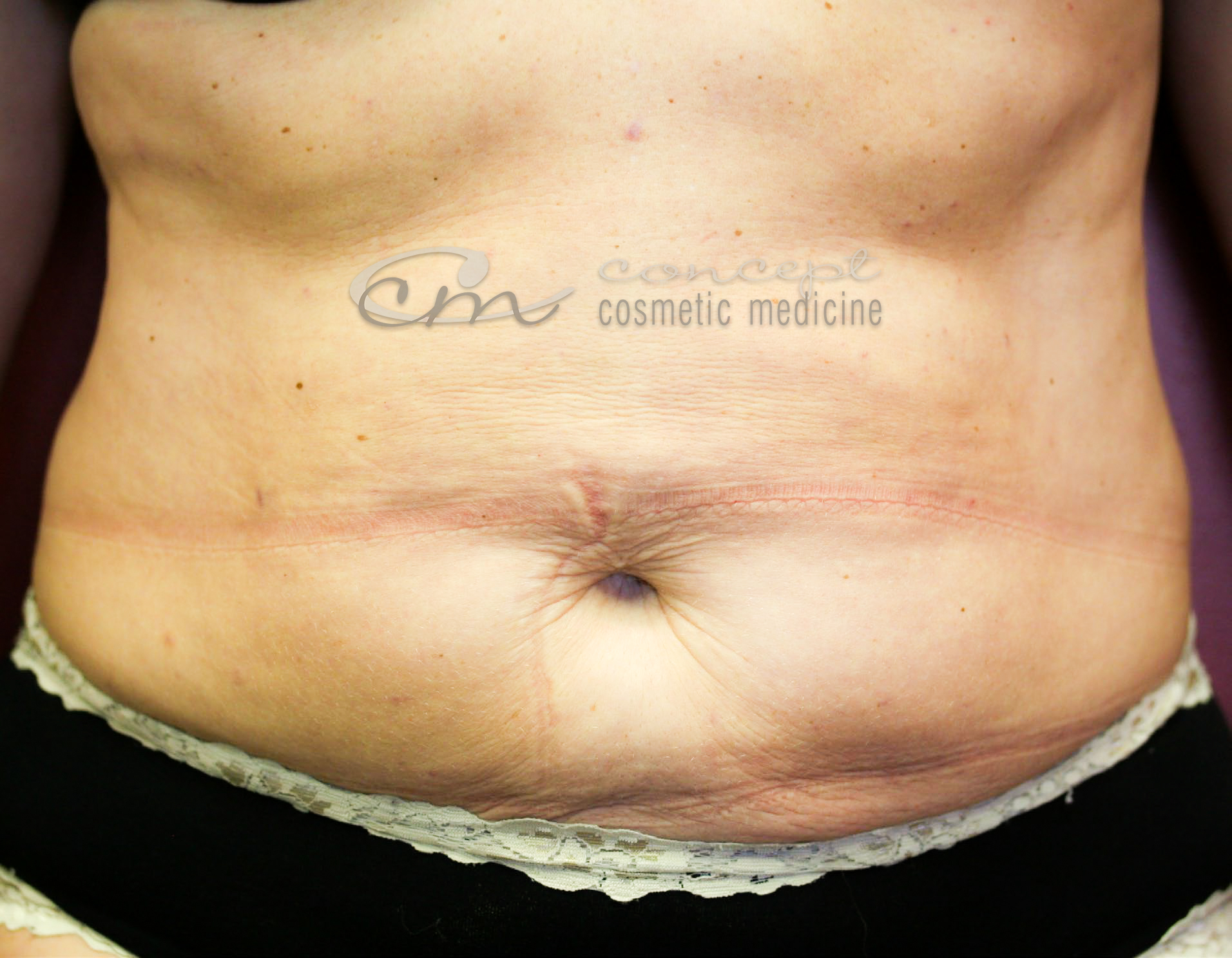 CCM Liposculpture - AFTER