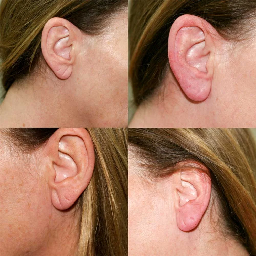 Before and After Earlobe Surgery