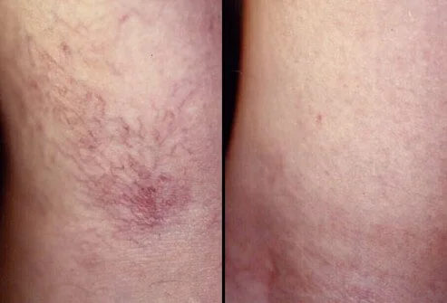 Before and After Sclerotherapy