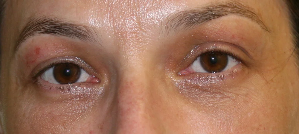 Eyelid Reduction - After