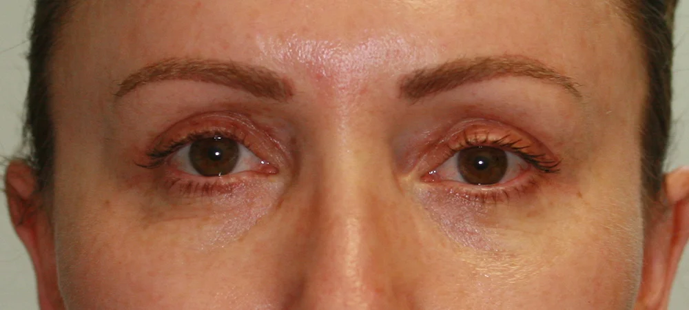 Eyelid Reduction - After