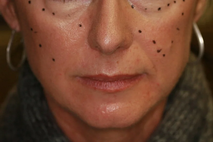 Liquid Facelift - Before