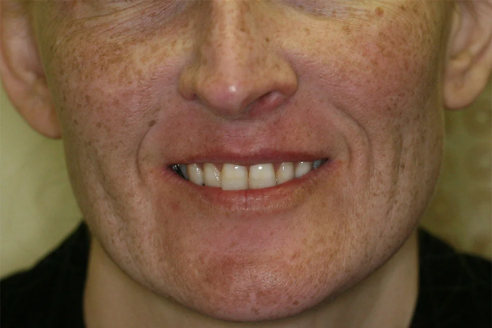 Chemical Peel - Before
