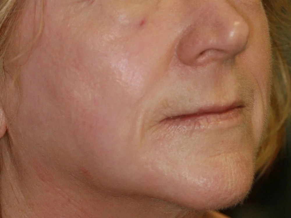 Collagen Induction Therapy - After